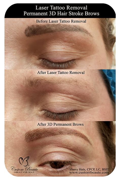 Laser Eyeliner Tattoo Removal and Laser Brow Tattoo Removal in in Phoenix Arizona | Sherry ...