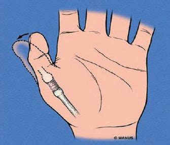 Stenosing Tenosynovitis Trigger Finger Causes - madathos