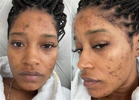 Keke Palmer Gets Real About Her Long-Time Struggle With Acne | Face acne, Acne remedies, Acne causes
