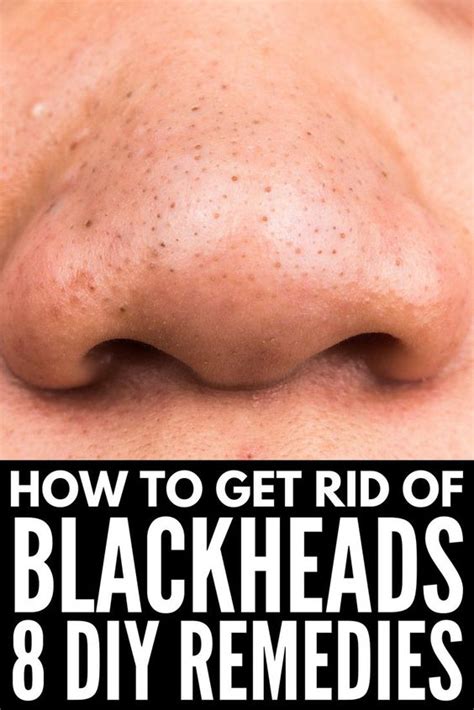 How To Remove Blackheads From Nose - TOP 5 DIY