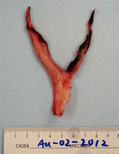 Contemporary Surgical Management of Acute Massive Pulmonary Embolism ...