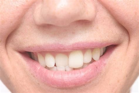 All You Need to Know About Teeth Straightening in KR Puram, Bangalore | by nimi DENTAL | Medium