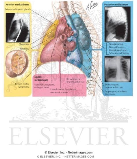 Tumors of Mediastinum