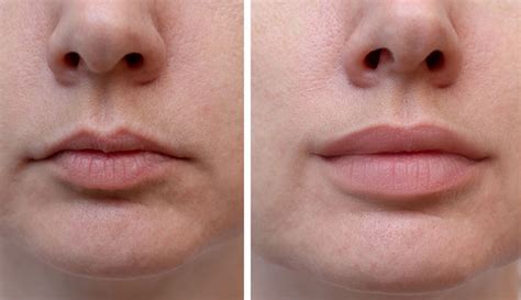 Lip Fillers: What to Expect, Types, Benefits & Side Effects