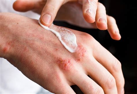 Topical Steroids: A Prescribed Medication for the Treatment of a Variety of Skin Problems ...