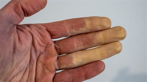 What Is Raynaud’s Disease? – NBC4 Washington