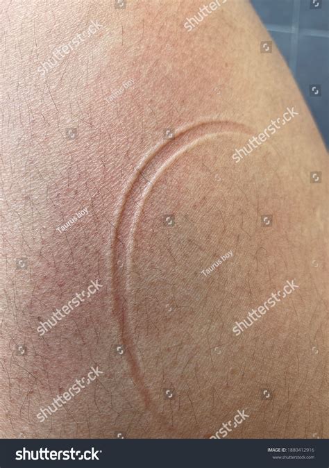 Scratch Marks On Skin Surface Stock Photo 1880412916 | Shutterstock