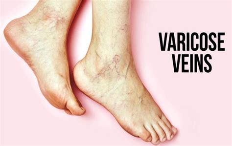 Varicose Veins - Symptoms, Causes, and Treatment