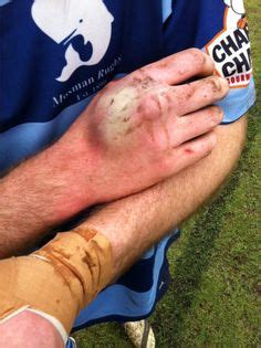 42 Best Rugby Injuries ideas | rugby injuries, injury, rugby