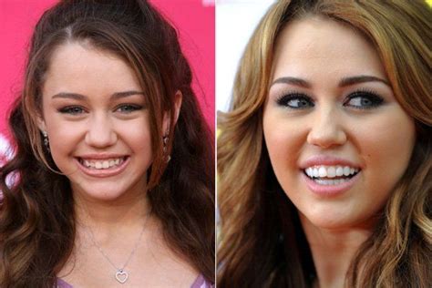 Miley Cyrus Braces And Teeth Transformation | Celebrity teeth, Miley ...