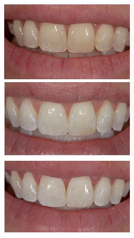 Smile Makeover: Teeth Whitening With Replacement Composite Bonding | Complete Family & Aesthetic ...