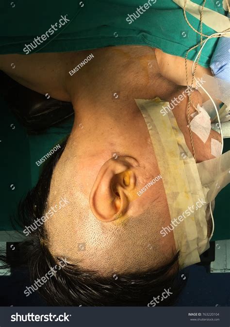 Preparing Mastoidectomy Surgery Procedure Stock Photo 763220104 ...