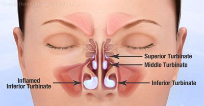 Turbinoplasty - ENT Florida