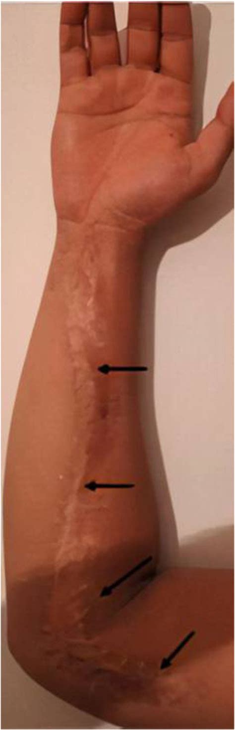 Optimizing wound closure following a fasciotomy. Fasciotomy was... | Download Scientific Diagram