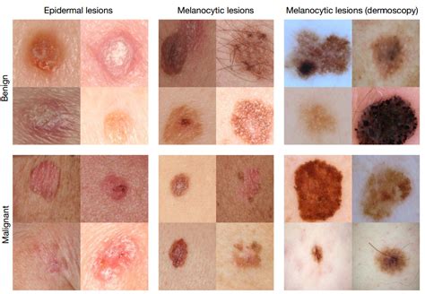 Deep learning algorithm diagnoses skin cancer as well as seasoned ...