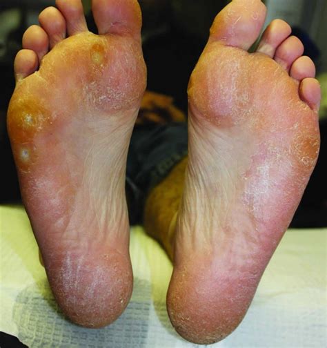 Tinea pedis, athlete's foot, causes, symptoms, diagnosis & treatment