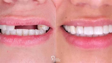 Dental Bridge Front Teeth