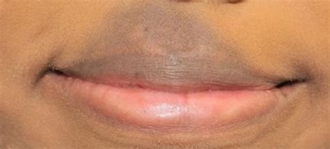 Causes and Treatments of Hyperpigmentation Around Mouth | New Health Advisor