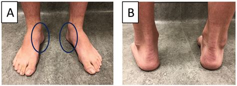 Subtle Cavovarus Foot: A Missed Risk Factor for Chronic Foot and Ankle Pathologies