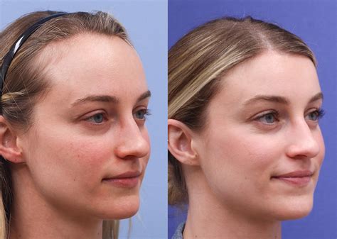 Unlocking Confidence: Surgery to Make Your Forehead Smaller - Culturaverde