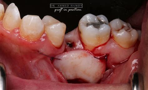 free gingival graft around implant (stage 1 )