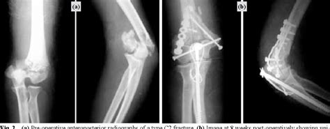 Figure 2 from Outcome of olecranon osteotomy in the trans-olecranon ...