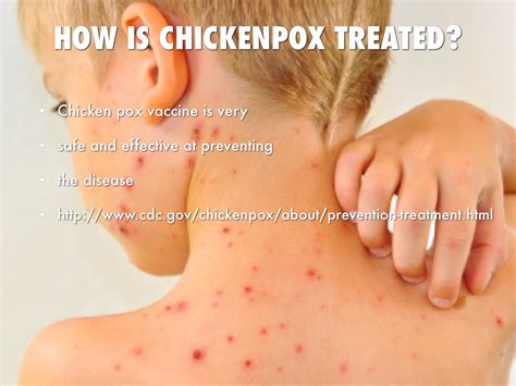 Chickenpox by Michael Johnson