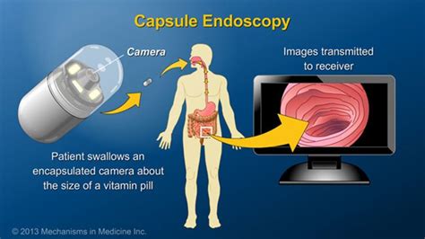 Capsule endoscopy is a relatively new procedure during which the patient swallows an ...