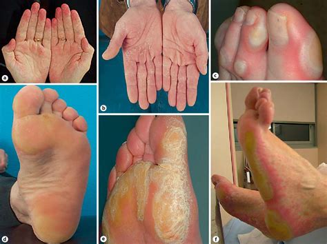 Figure 1 from Hand-Foot Syndrome (Hand-Foot Skin Reaction, Palmar ...