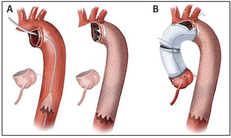 Aortic Endovascular Grafting Thoracic Key | My XXX Hot Girl