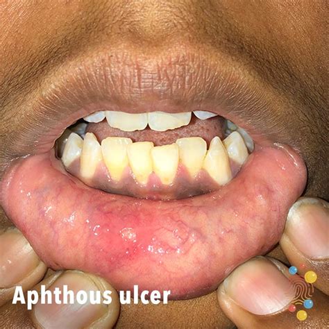 Major Aphthous Ulcers