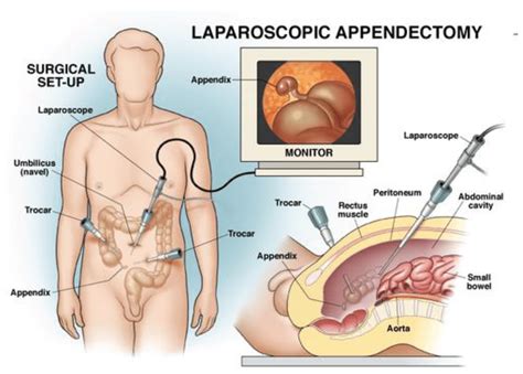 Laparoscopic Appendix Removal (Appendectomy) Surgery Patient Information