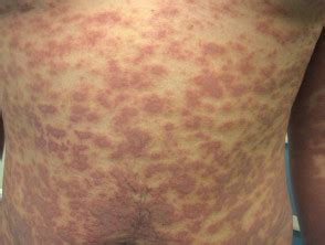 Infección por Mycoplasma pneumoniae - Dermatly.com - El sitio de tu piel
