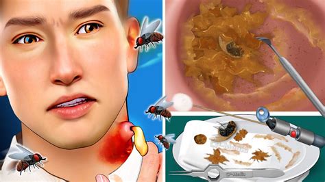 ASMR Botfly Maggot & Fly Larvae Removal in Man's Ear - YouTube