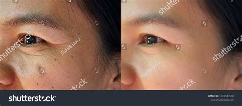 Image Before After Dark Spot Melasma Stock Photo 1522943588 | Shutterstock