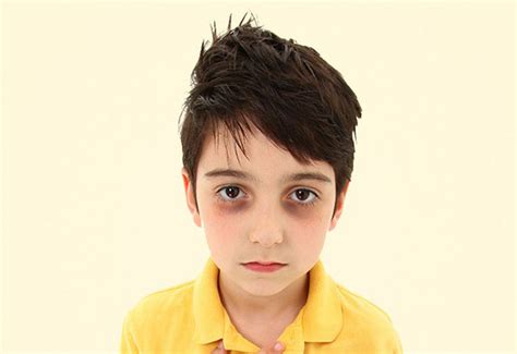 Trẻ bị thâm quầng mắt có sao không? Điều trị như thế nào?