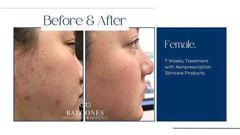 Accutane Before & After Gallery - Austin, TX: Balcones Dermatology & Aesthetics