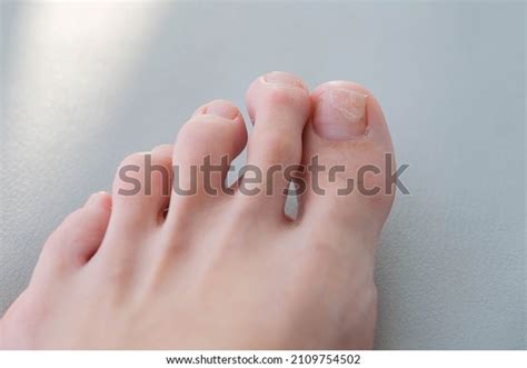 1,583 Mycosis On Nails Images, Stock Photos & Vectors | Shutterstock