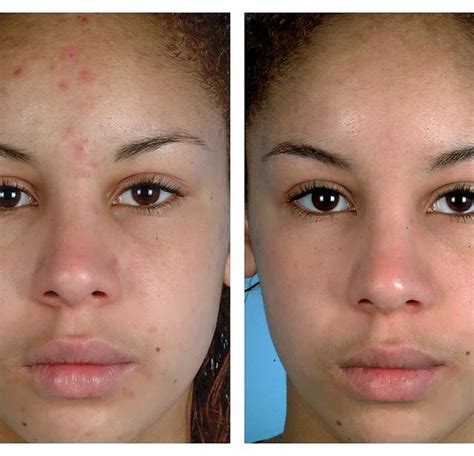 Microdermabrasion Before and After (Results + Pictures) - the daily glimmer