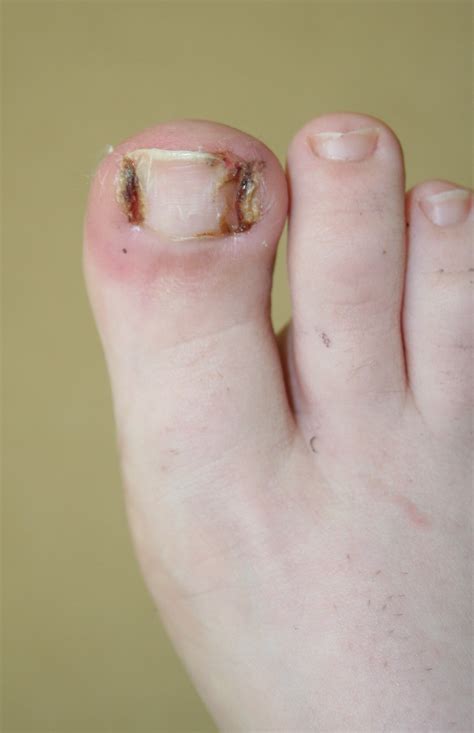 Ingrown Toenail Surgery - Buderim Podiatry | Sunshine Coast podiatrist ...