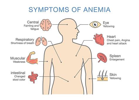 Anemia Symptoms; What Are the Symptoms of Anemia? - Healthella