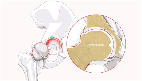 Labral Tears and a Track Athlete - Surgery on Kids - Regenexx