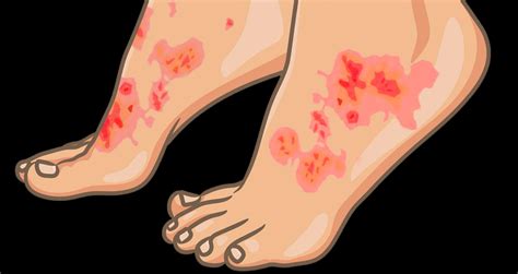 What Is Plaque Psoriasis? Symptoms, Causes & Treatments