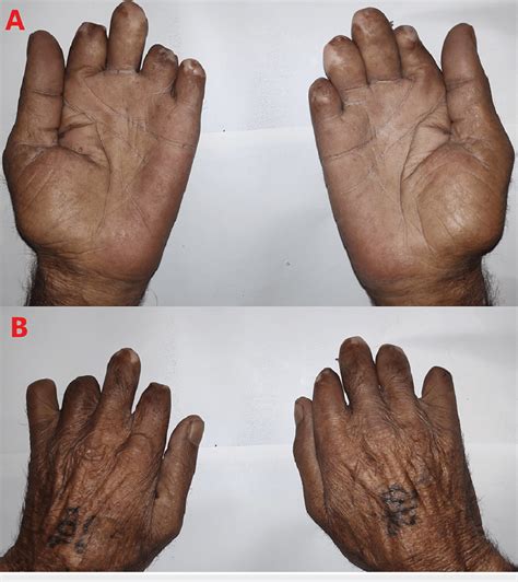 Amputated fingers of both hands (A and B) with intact thumbs ...