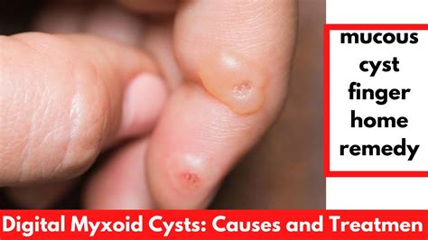 Mucous cyst finger home remedy | Digital Myxoid Cysts: Causes and Treatment - YouTube