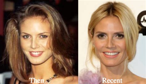 heidi-klum-botox-before-and-after - Latest Plastic Surgery Gossip And News. Plastic Surgery Tips ...