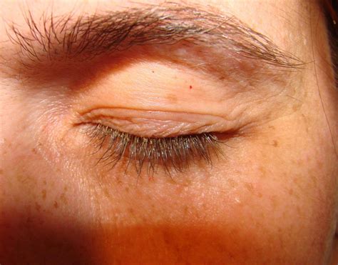 26 New What Causes Eyelash Lice - Demodectic Mange