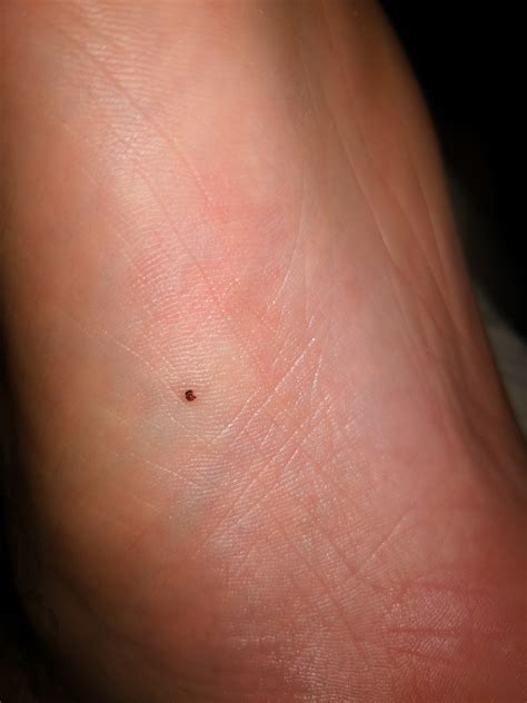 Melanoma on buttom of my foot? : DiagnoseMe