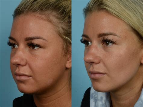 Buccal Fat Removal Before and After Pictures Case 714 | Chicago, IL | TLKM Plastic Surgery