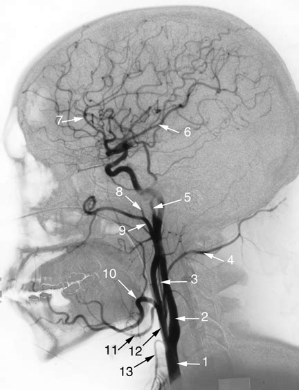 Medical School • Angiogram of the head: Common Carotid Artery.